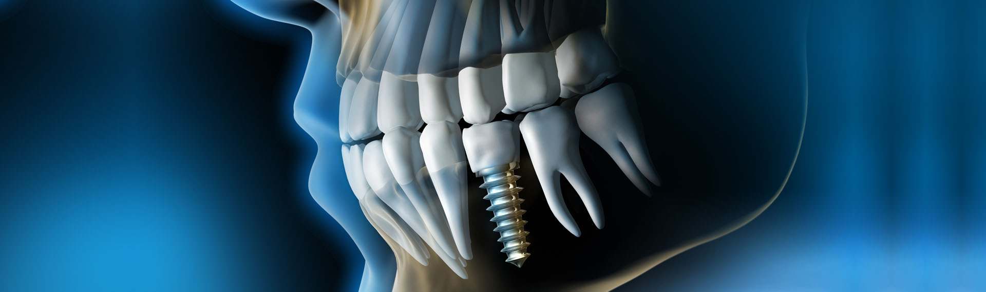 Wait you for Dental Implant Treatment!
